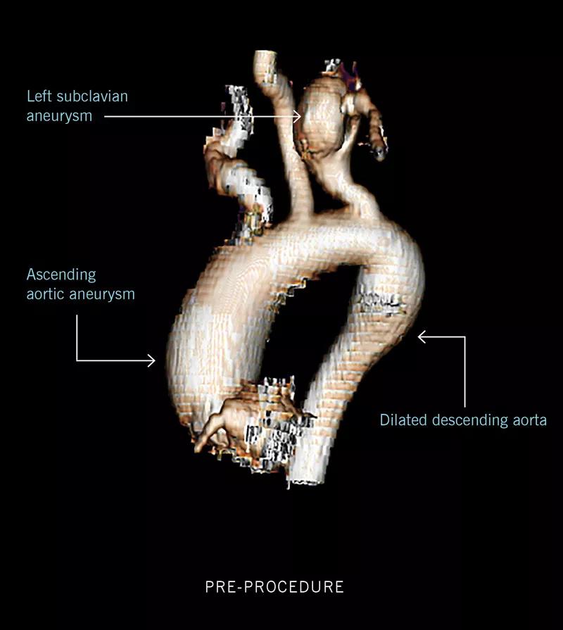 Loeys-Dietz syndrome