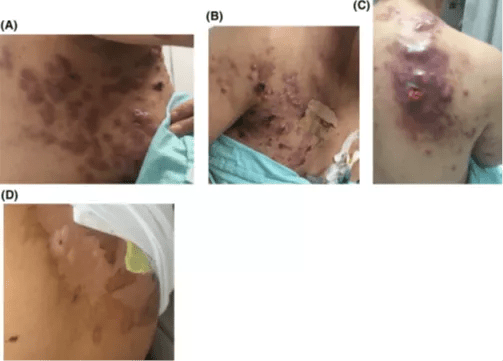 Pictures of patients treated with postmastectomy radiation therapy (PMRT).