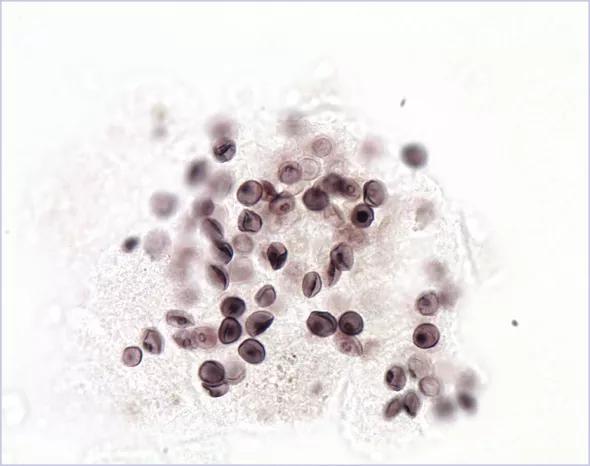Figure. Image of a bronchoalveolar lavage specimen positive for Pneumocystis jirovecii (GMS stain). Courtesy of Sandra S. Richter, MD, Cleveland Clinic.
