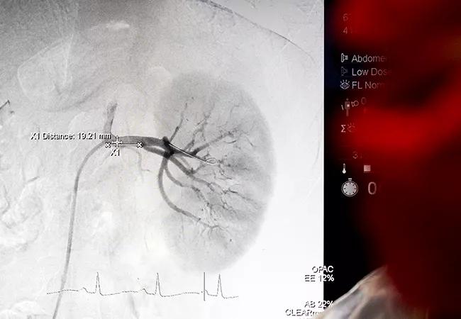 Insights From Early Post-Approval Cases of Renal Denervation for 