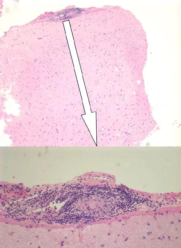 Figure 4. Temporal lobe biopsy findings two months after presentation show a noncaseating granuloma characterized by lymphocytes, epithelioid histiocytes and a multinucleated giant cell in the leptomeninges adjacent to a small artery. Multiple veins in the meninges show perivascular and intramural lymphocytes. These histologic findings are compatible with a primary vasculitis of the central nervous system. 