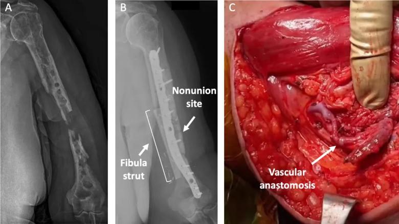 Radiographs of the staged surgeries