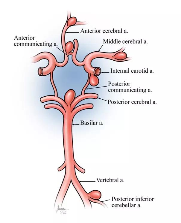 illustration showing intracranial aneurysm development
