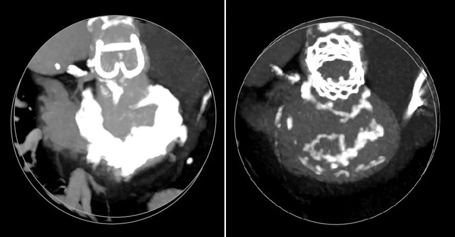 two circular scans of the heart showing white areas of calcification