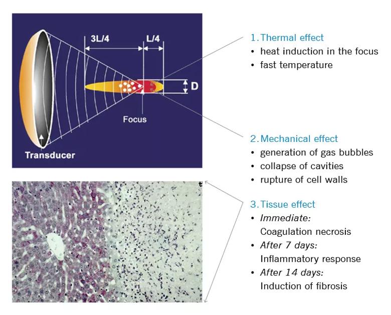 (schematic) Tissue impact footprint is 1.7 mm diameter x 24 mm maximum length