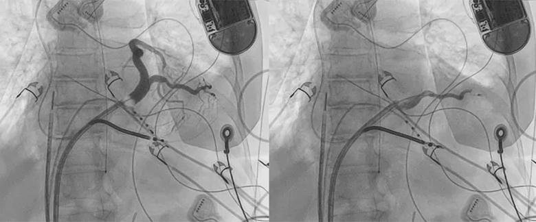 Videos depicting selection of the target distal coronary sinus branch for intentional perforation