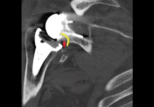 Scapular Notching Following Reverse Total Shoulder Arthroplasty