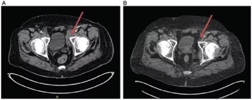 A reduction in adenopathy was observed despite talimogene laherparepvec injections only at site of lesions in lower extremity