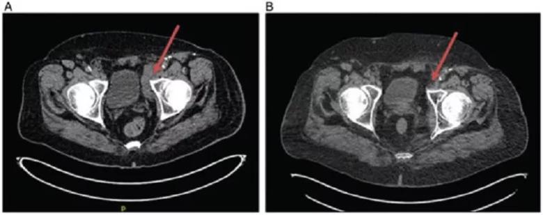 A reduction in adenopathy was observed despite talimogene laherparepvec injections only at site of lesions in lower extremity