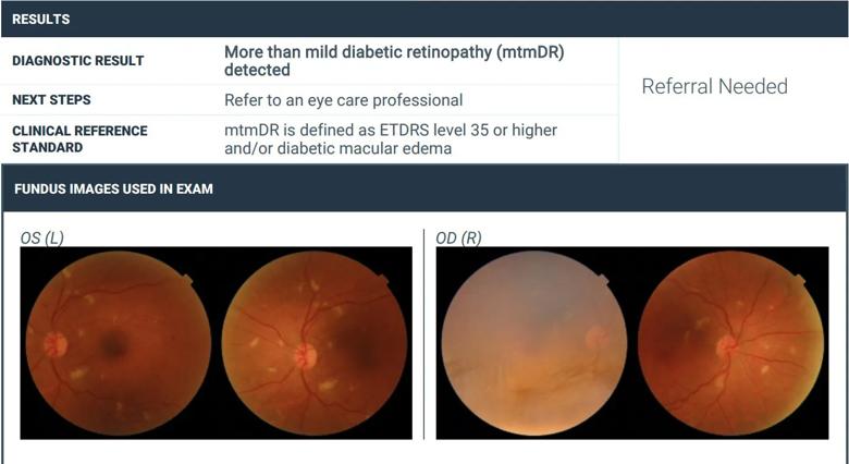 Retina screening with an AI-powered fundus camera