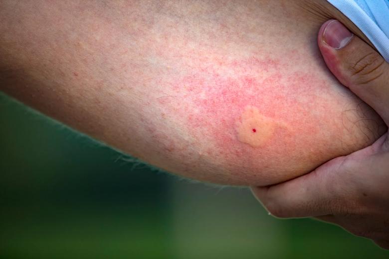 closeup of a mosquito bite on an arm