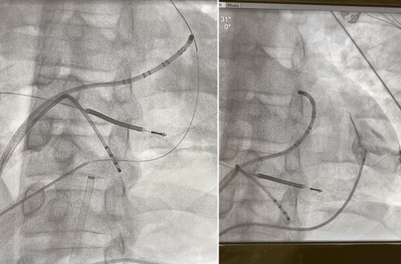 coronary angiogram during ablation procedure