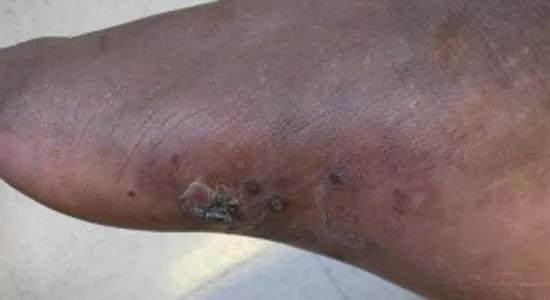 Kaposi sarcoma in the right foot.