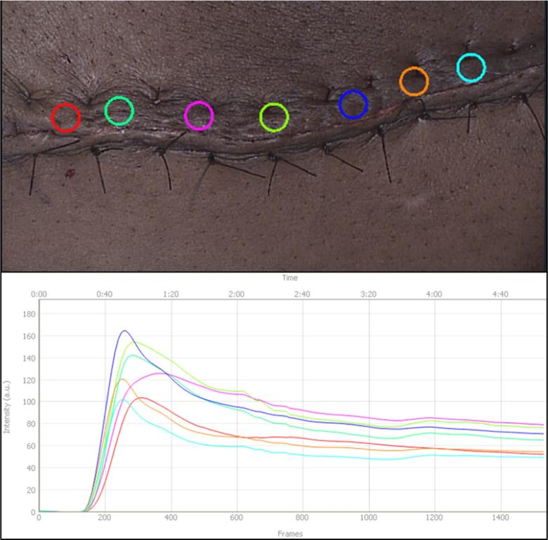 Skin incision with stitches and graph of measurements