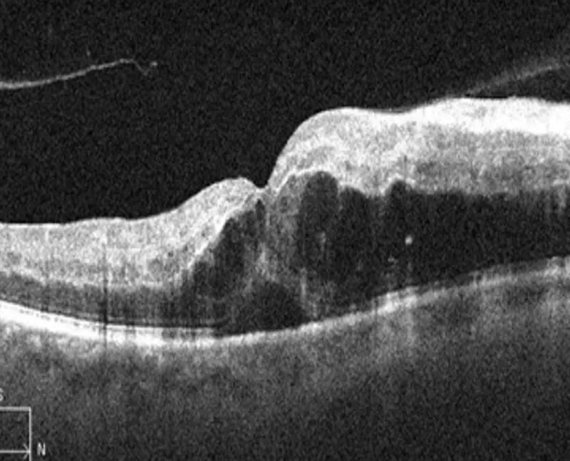 OCT image of a retinal vein occlusion demonstrating significant intraretinal fluid