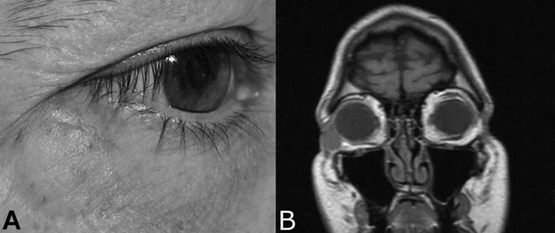 A. External photograph showing inferotemporal orbital nodule B. T1 weighted coronal MRI showing well-circumscribed nodule in the inferotemporal orbit, which is isointense to muscle