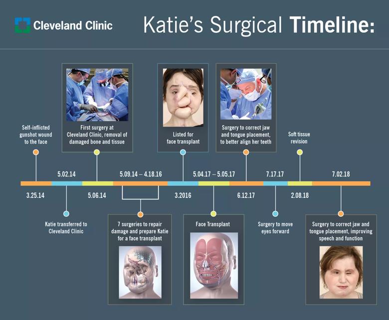 Katie Stubblefield face transplant Cleveland Clinic