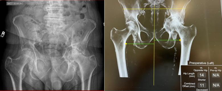 X-rays of hip deformity