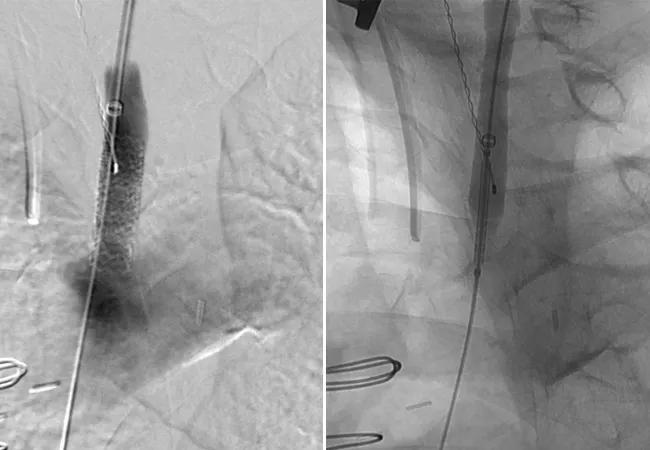 retrograde proximal common carotid artery stenting with a balloon-expandable stent