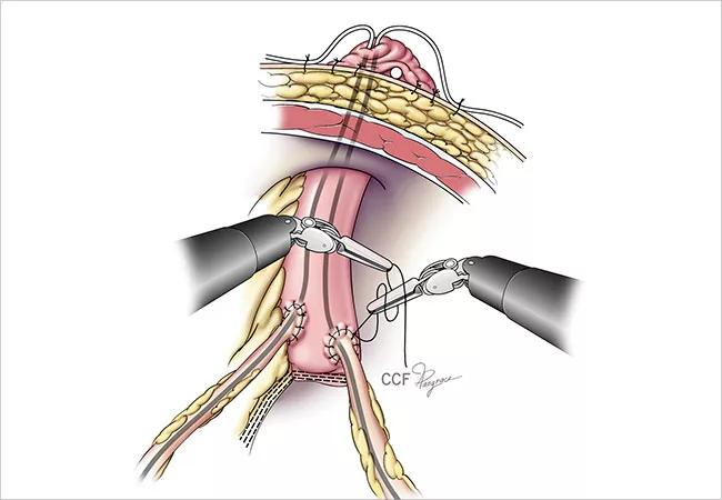 Navigating the Learning Curve in Intracorporeal Urinary Diversion