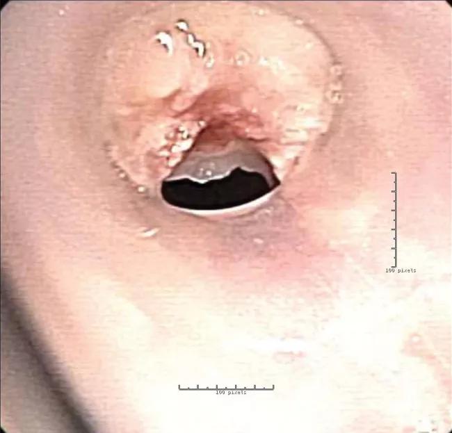 Left main bronchus with granulation occluding the stent.