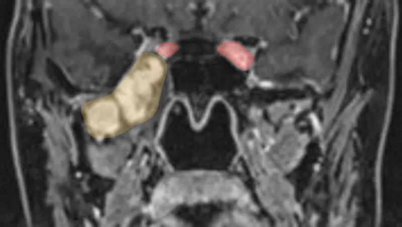 brain scan with two structures colored in tan and two small structures colored in pink