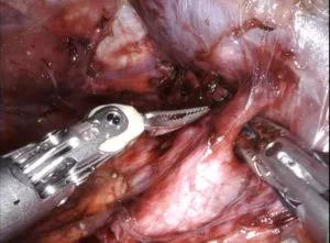 liver resection