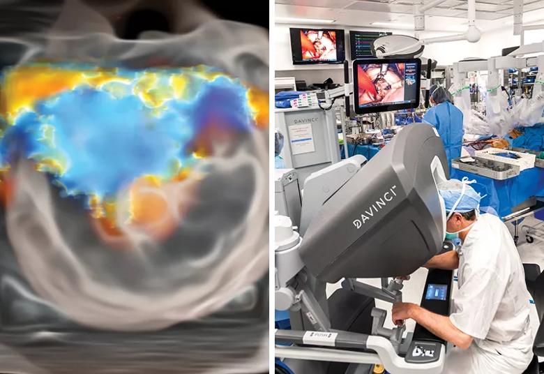 images of mitral prolapse and robotic surgery to correct it