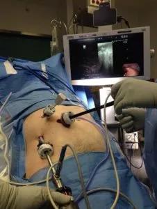Intraoperative photo of laparoscopic ablation