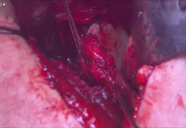 Capsule repaired to bone graft