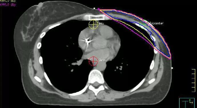 Cardiac-Sparing Radiation for Breast Cancer