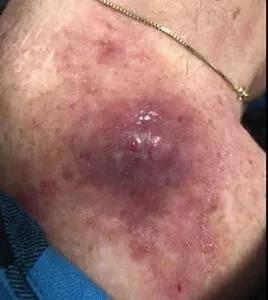photo of skin cancer lesion