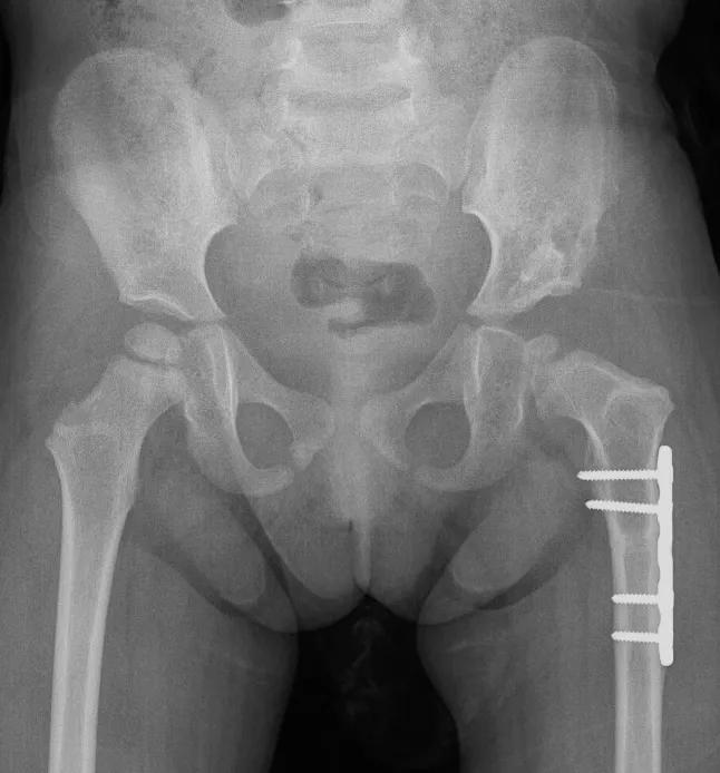 X-ray of pelvis