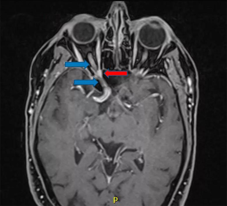 human brain MRI showing a schwannoma tumor compressing the optic nerve