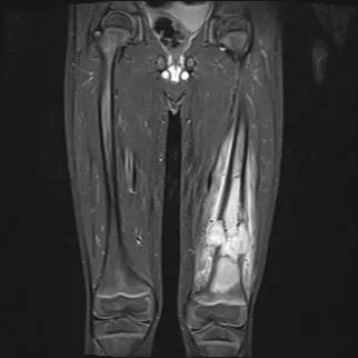 Rare surgery helps young patient with osteosarcoma