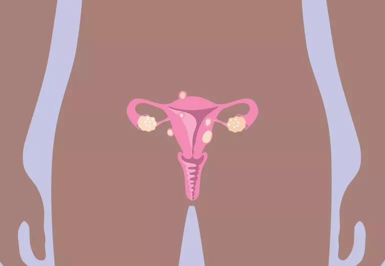 Can Uterine Fibroids Cause Weight Gain?