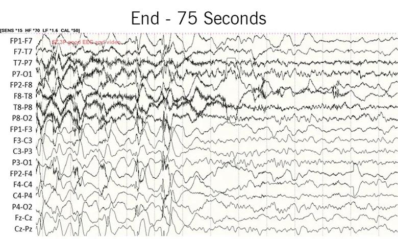 EEG recording