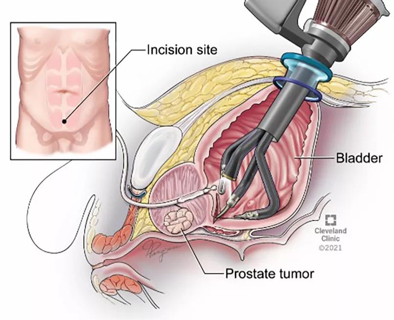 Illustration of transvesical single-port radical prostatectomy