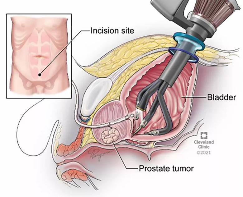 Figure 2. Transvesical Single Port Radical Prostatectomy. Note the robot is introduced directly through the skin into the bladder. 