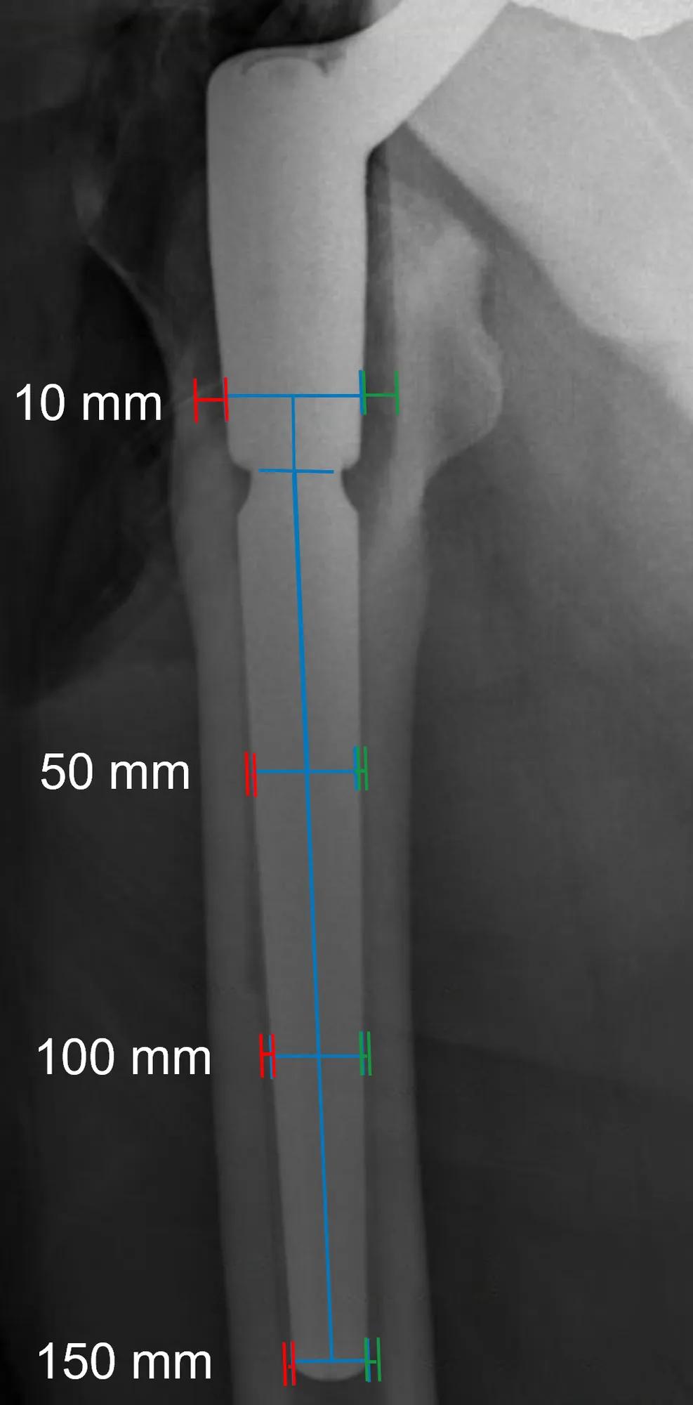 X-ray of hip implant