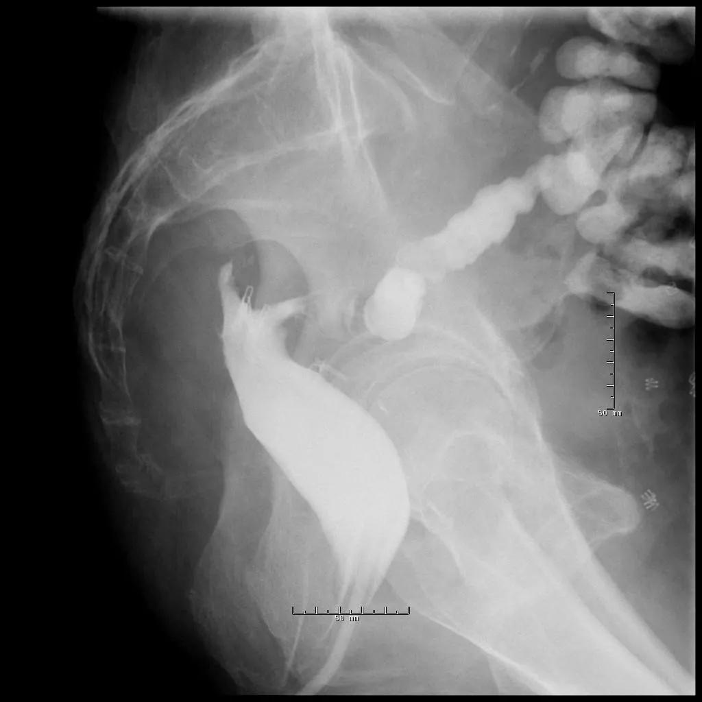 Treated sinus track, almost resolved.