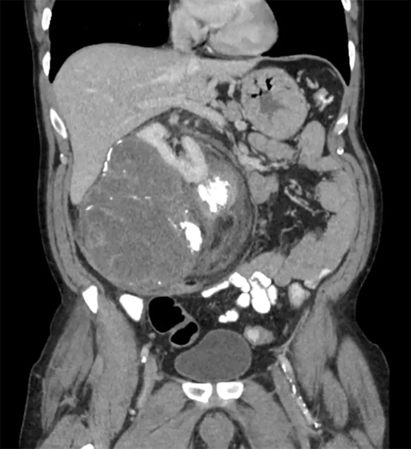 CT scan