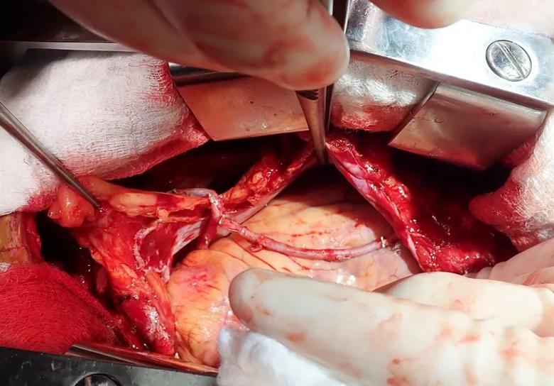 coronary artery bypass operation