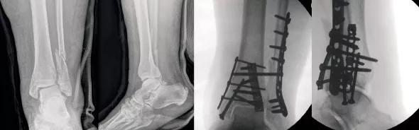 Figure 1. (A, B) Injury radiographs showing ankle fracture in a diabetic patient with a history of gastric bypass surgery and kidney-pancreas transplantation on immunosuppressive medications. (C, D) Aggressive and comprehensive internal fixation was performed, including placement of a posterolateral fibular locking plate, posterior and medial buttress plates and a supplementary syndesmotic screw.