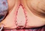 Placement of the vertical rectus abdominis myocutaneus flap in the perineal defect.