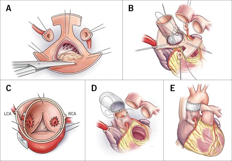 illustrations of five steps in a heart valve operation