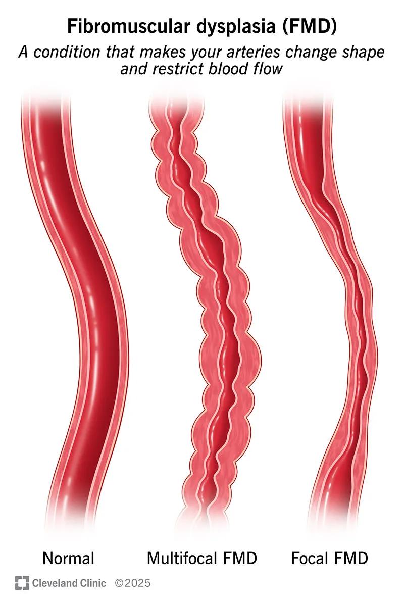 Normal, multifocal and focal fibromuscular dysplasia arteries