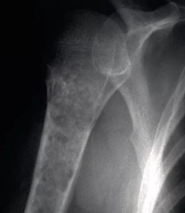 Figure 3. Radiograph showing a chondroid tumor in the proximal humerus with endosteal scalloping, cortical destruction, periostitis and calcifications consistent with chondrosarcoma.