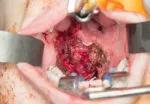 Figure 4. Soft palate defect