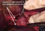 First-stage hepatectomy showing ligation of right anterior and right posterior portal veins.